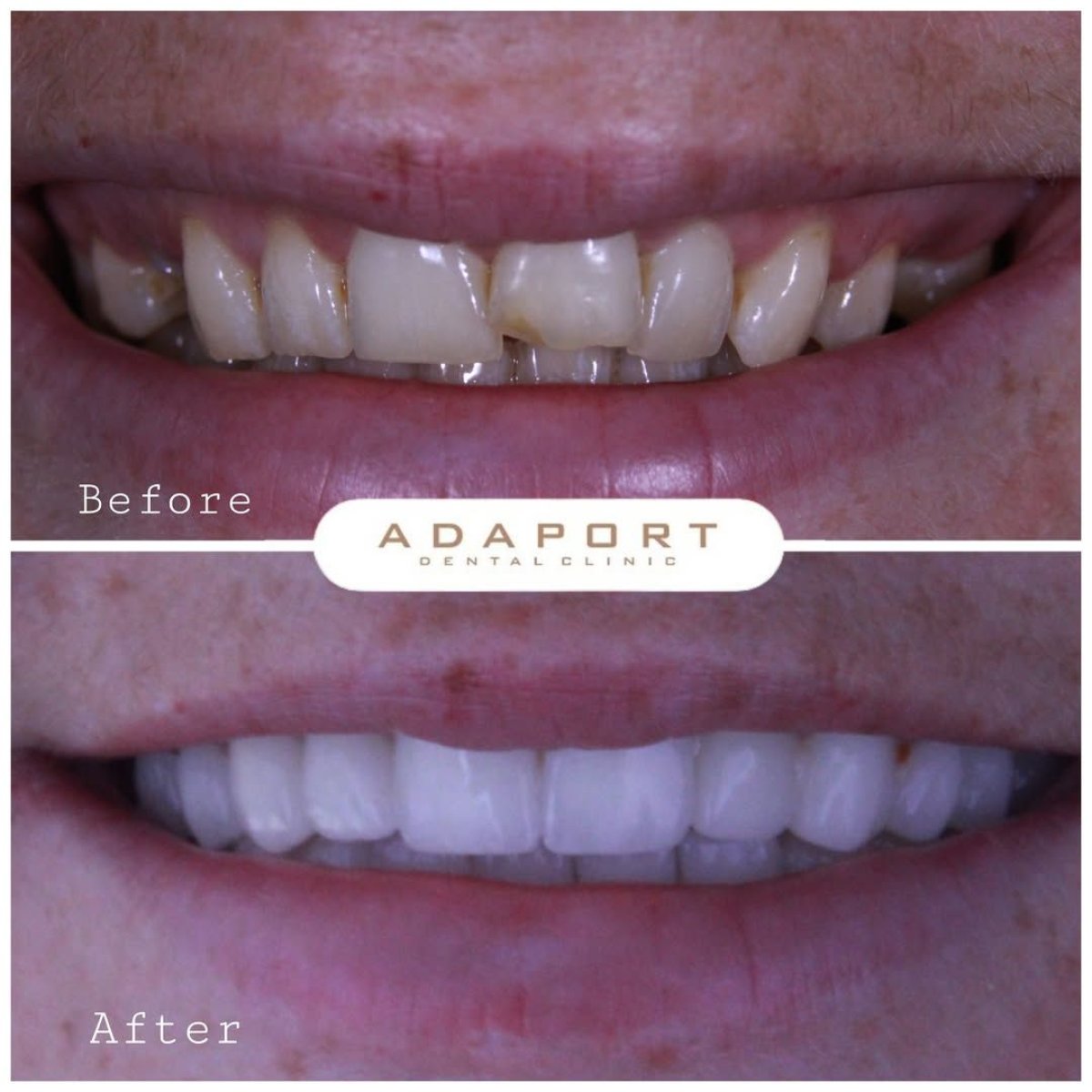 قبل وبعد فينير Emax في عيادة Adaport Dental Clinic – نتائج تحول الابتسامة