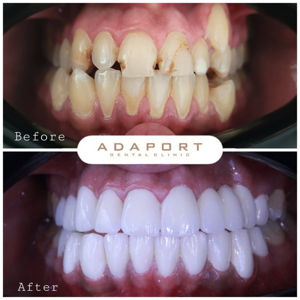 قبل وبعد فينير Emax في عيادة Adaport Dental Clinic – نتائج تجميل الابتسامة