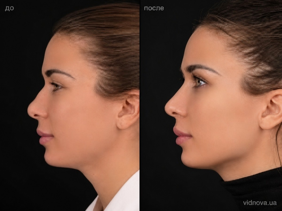 Before and after rhinoplasty results at Veselibu Clinic, improved nose shape and profile