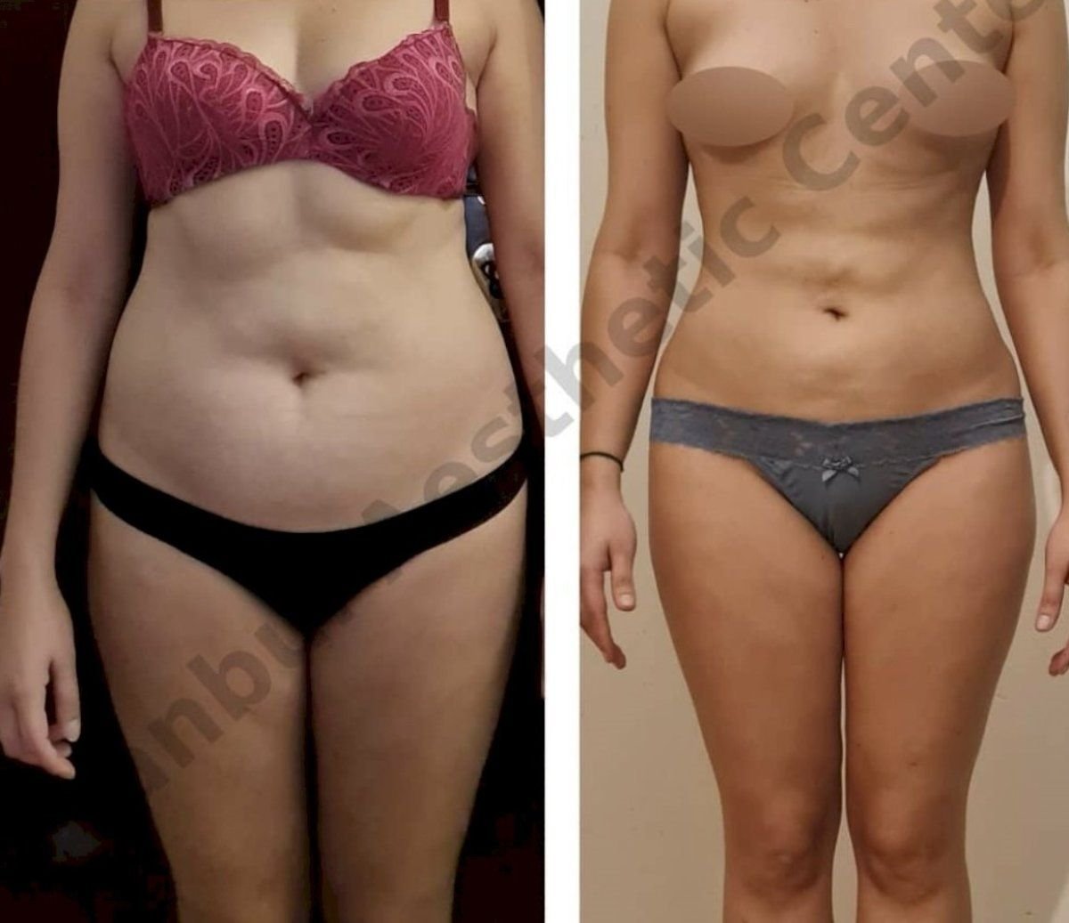 Before and after liposuction 3 body areas result at Istanbul Aesthetic Plastic Surgery Center
