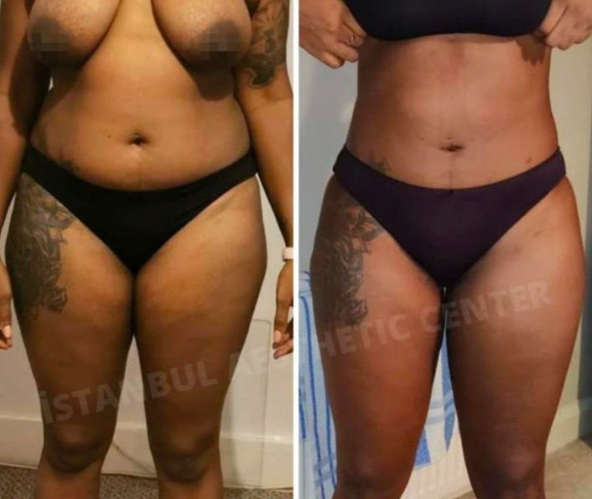 Résultat avant/après liposuccion 3 zones à Istanbul Aesthetic Plastic Surgery Center