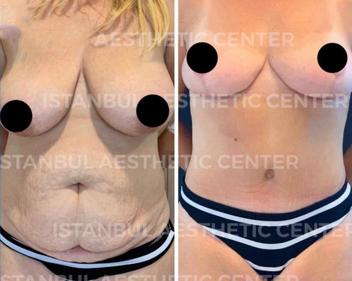 Before and after tummy tuck and breast lift results at Istanbul Aesthetic Plastic Surgery Center