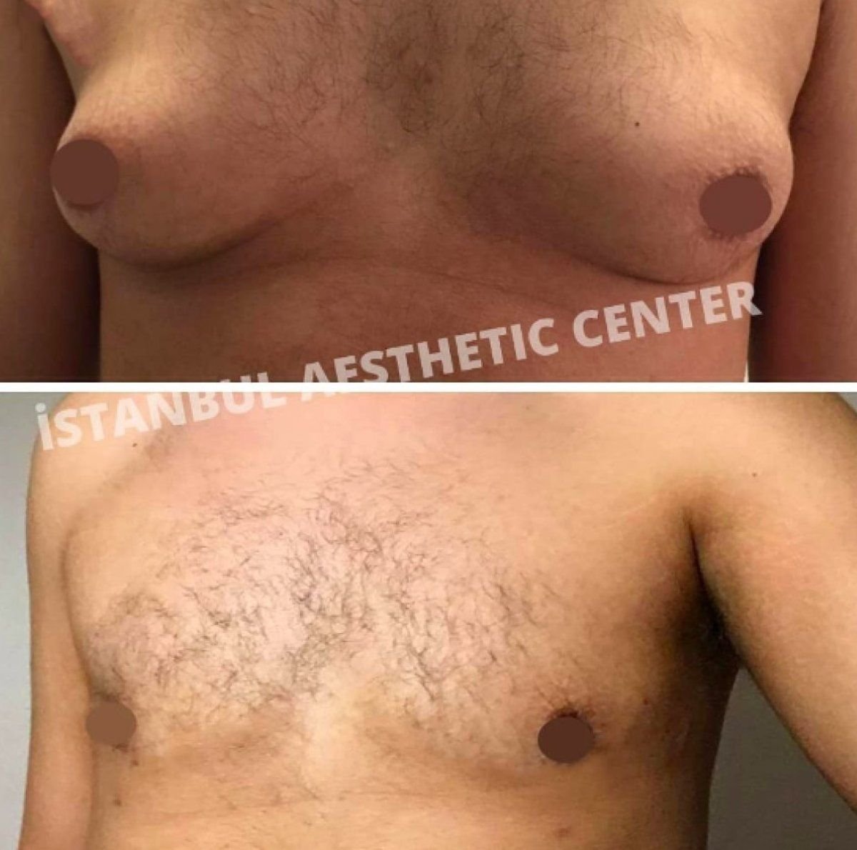 Gynecomastia Vaser liposuction before and after results at Istanbul Aesthetic Plastic Surgery Center