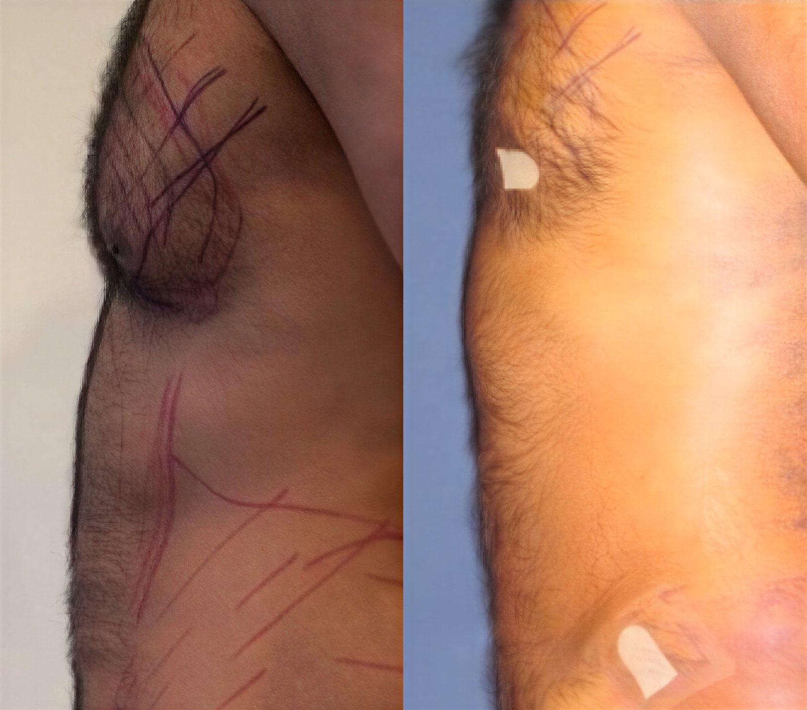 Resultados antes y después de liposucción Vaser para ginecomastia en Istanbul Aesthetic Plastic Surgery Center