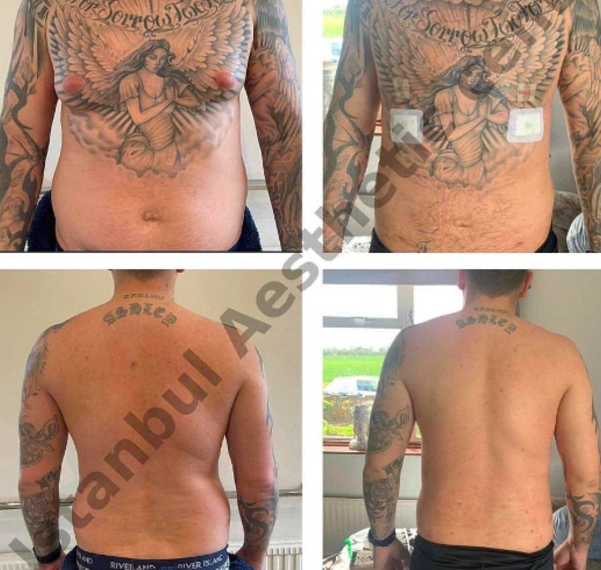 Gynecomastia Vaser liposuction before and after results at Istanbul Aesthetic Plastic Surgery Center
