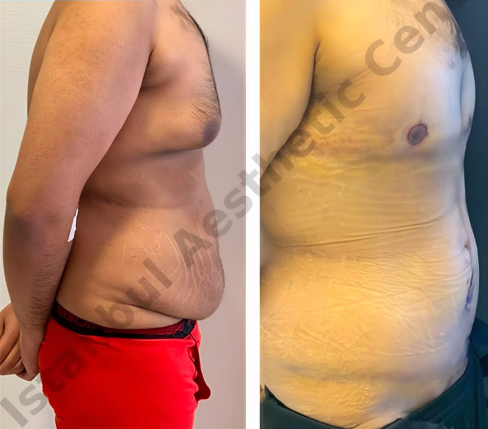 Resultados antes y después de liposucción Vaser para ginecomastia en Istanbul Aesthetic Plastic Surgery Center