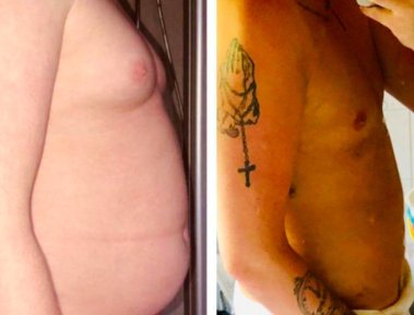 Gynecomastia with VASER Technology — 5-Night Stay Hotel & Transfer Included - photo 5