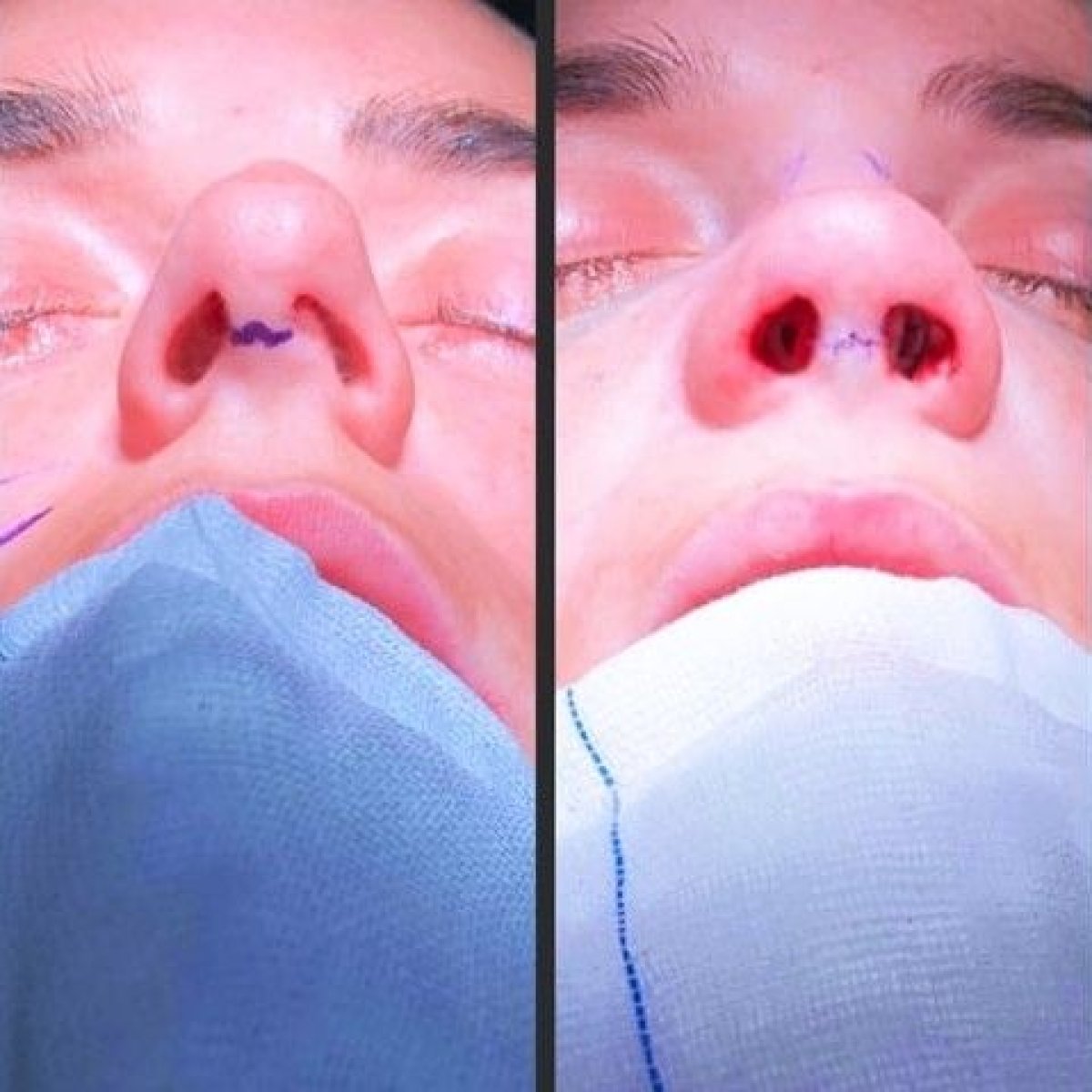 Before and after septoplasty results at Istanbul Aesthetic Plastic Surgery Center, improved airflow