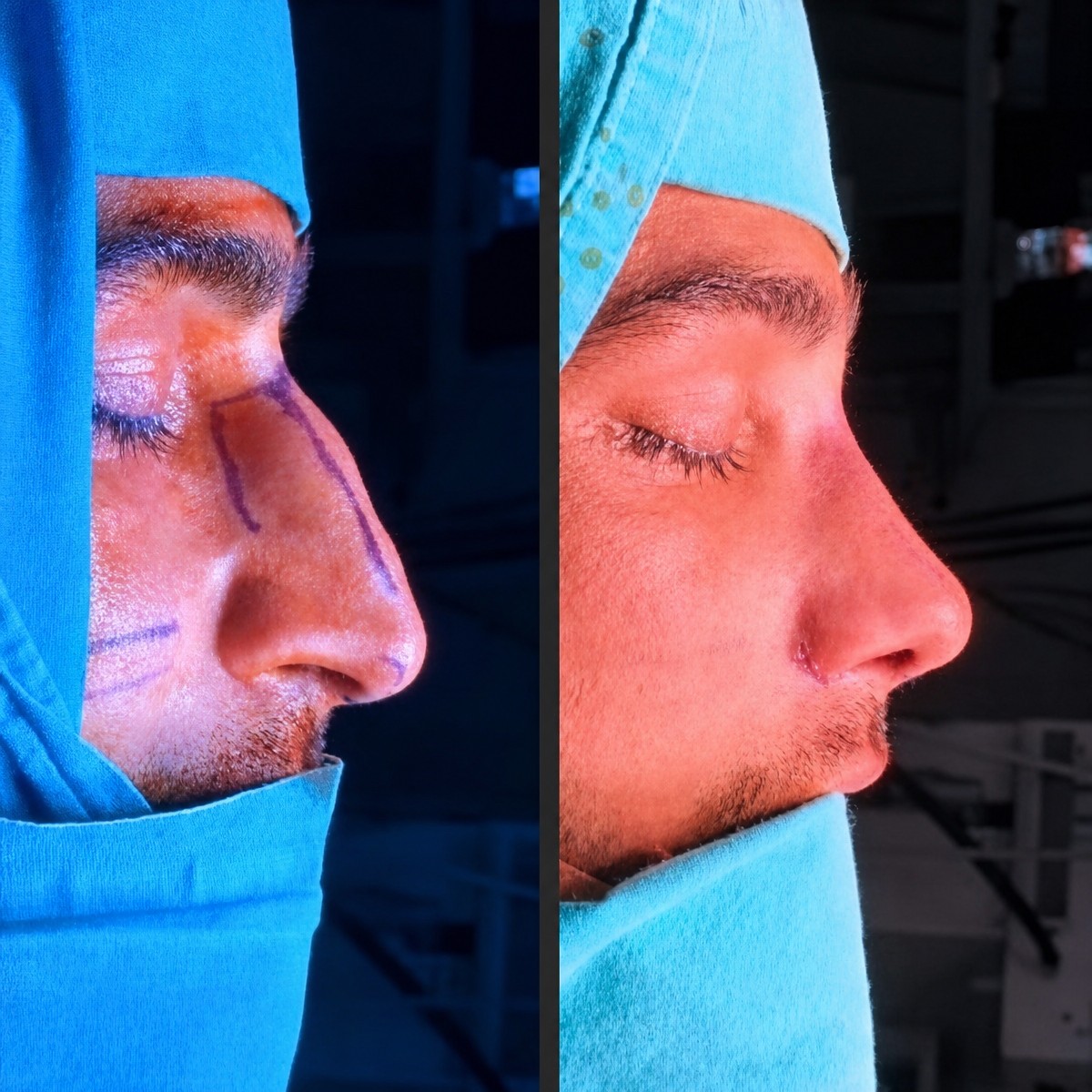 Результаты до и после септопластики в Istanbul Aesthetic Plastic Surgery Center, улучшена форма носа