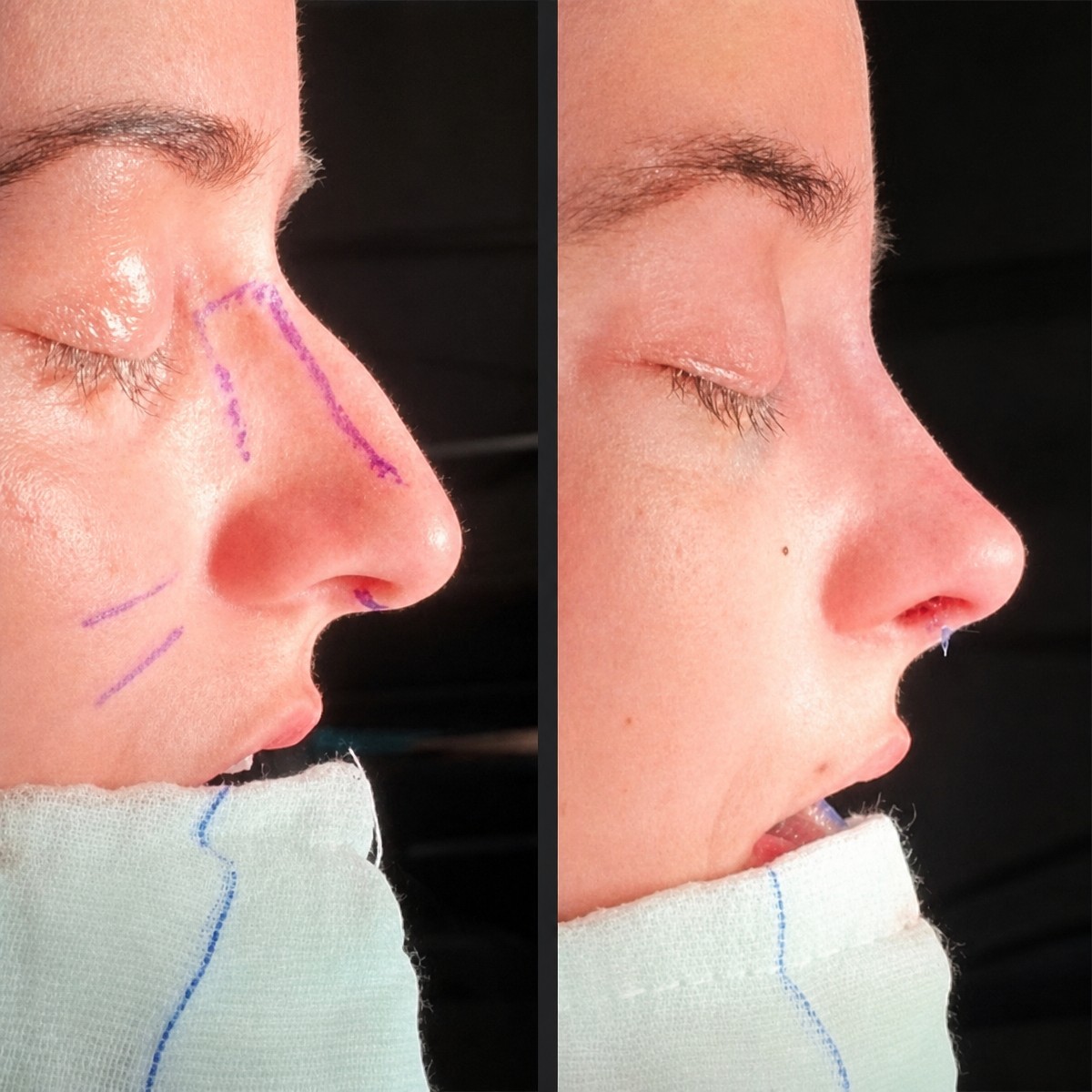 Результаты до и после септопластики в Istanbul Aesthetic Plastic Surgery Center, улучшен профиль носа