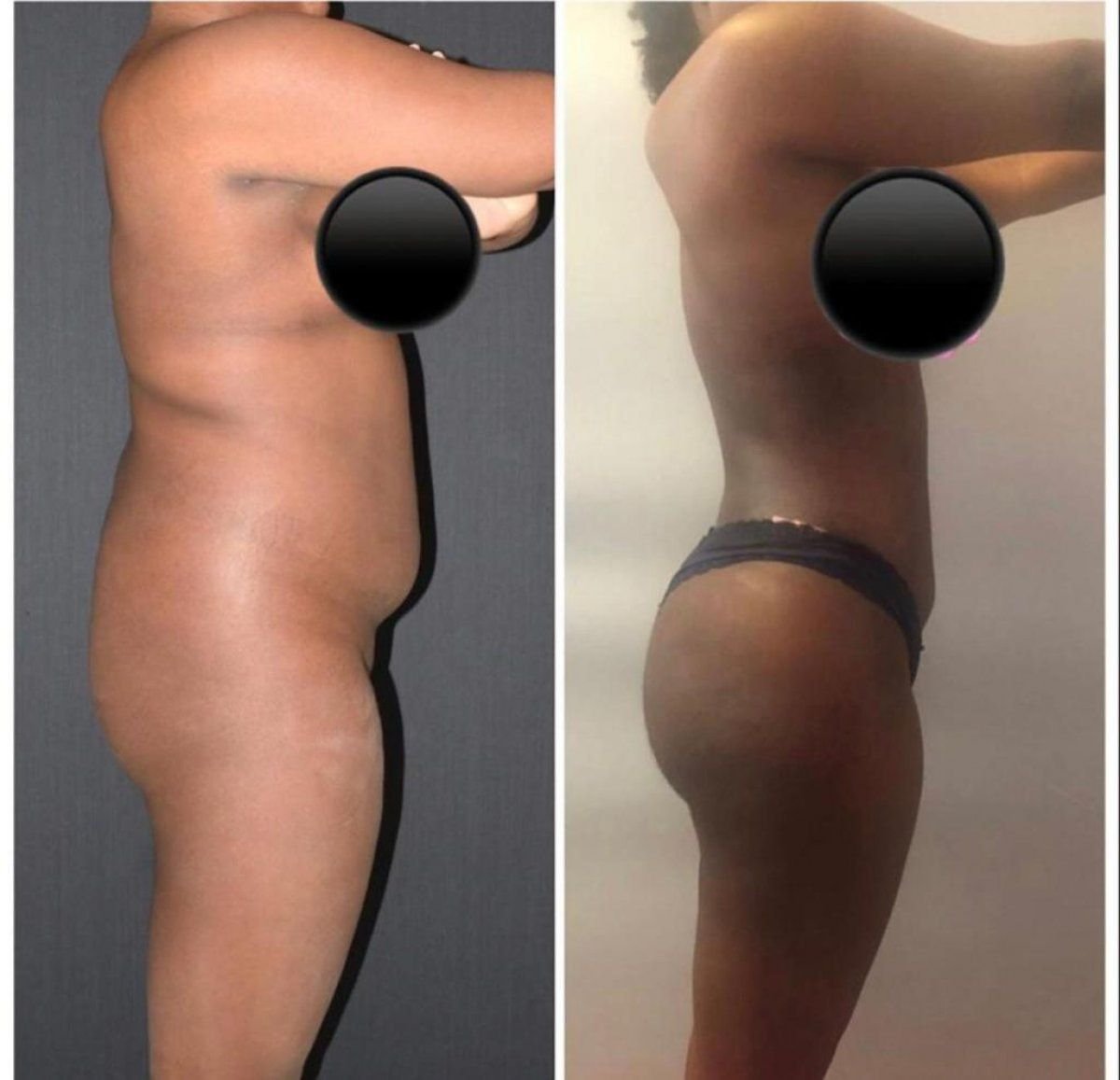 Résultats avant/après body lift complet à Istanbul Aesthetic Plastic Surgery Center