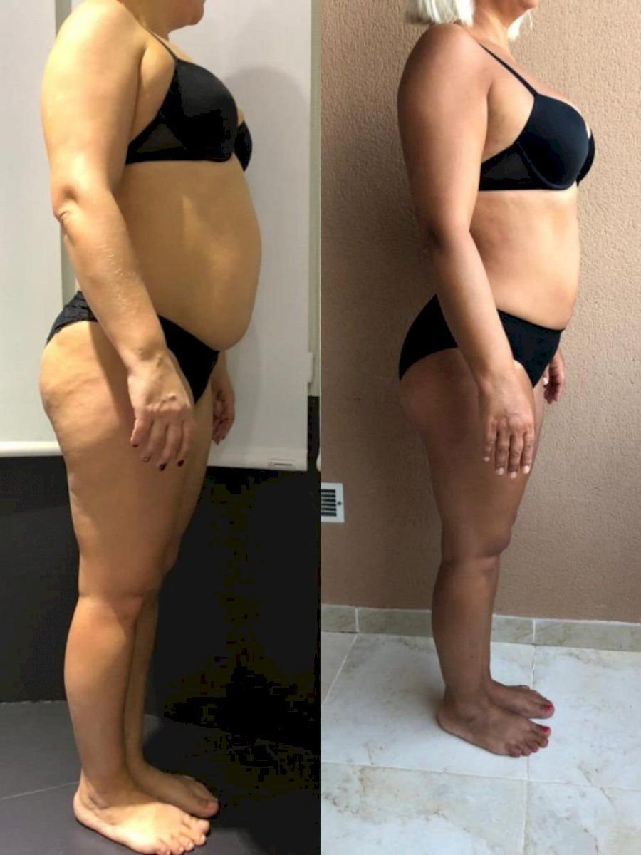 Результаты до и после круговой подтяжки тела в Istanbul Aesthetic Plastic Surgery Center