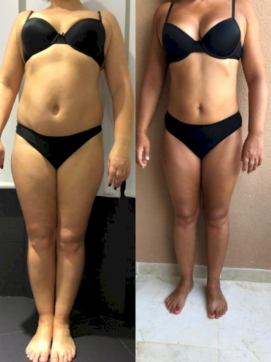 Résultats avant/après body lift complet à Istanbul Aesthetic Plastic Surgery Center, remodelage