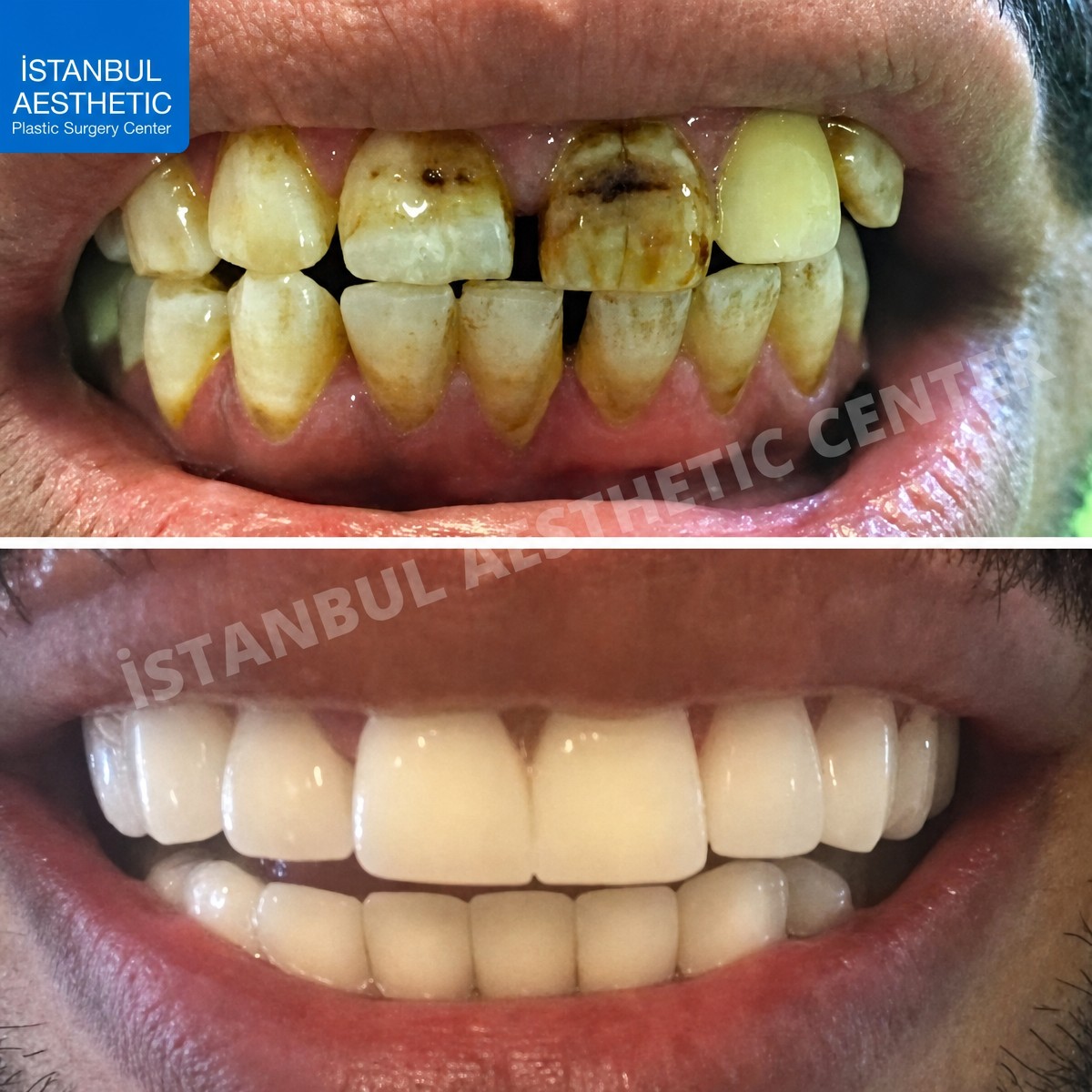 Before and after zirconia crown results at Istanbul Aesthetic Plastic Surgery Center, smile makeover