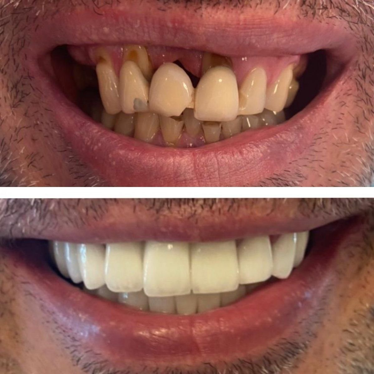 Vorher-nachher-Ergebnis Zirkonkrone bei Istanbul Aesthetic Plastic Surgery Center