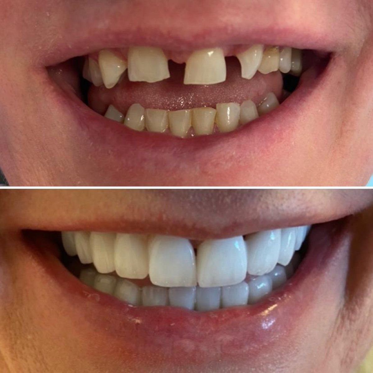 Before and after zirconia crown results at Istanbul Aesthetic Plastic Surgery Center, smile makeover
