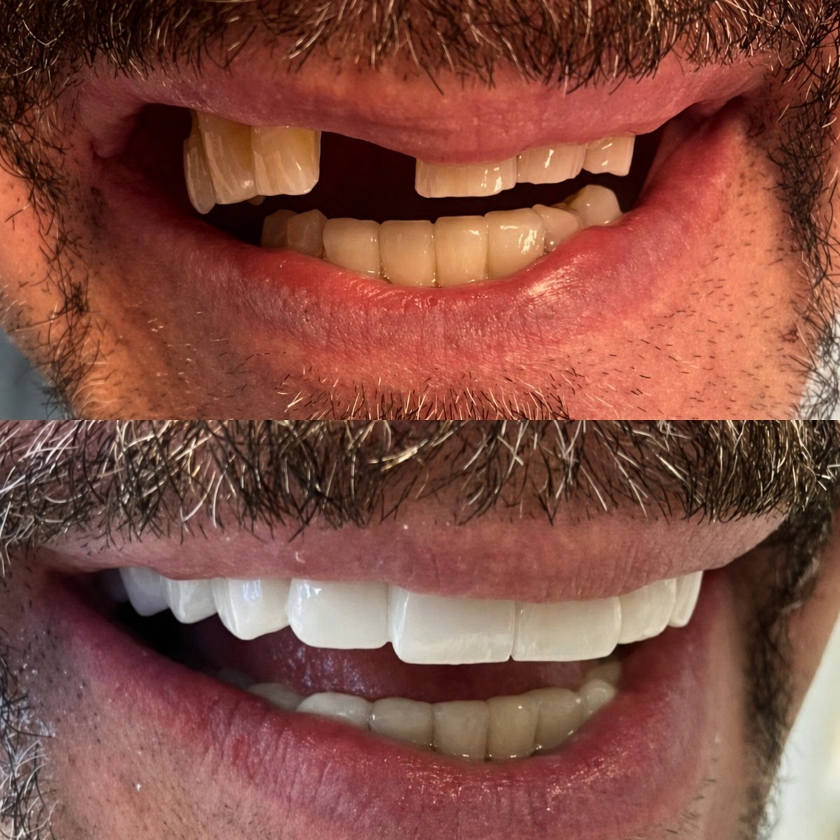 Результаты до и после установки циркониевых коронок в Istanbul Aesthetic Plastic Surgery Center
