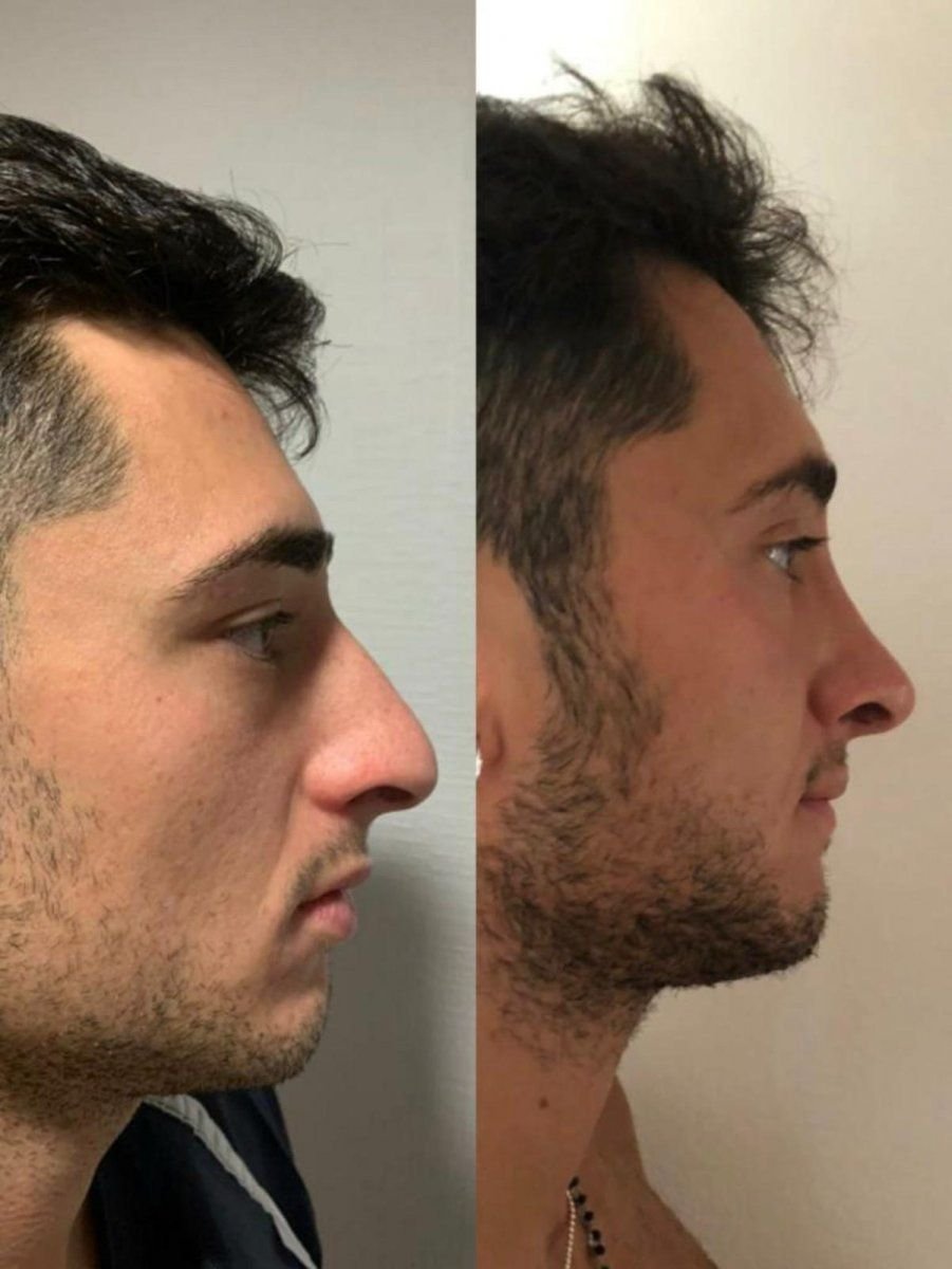 Before and after revision rhinoplasty results at Istanbul Aesthetic Plastic Surgery Center