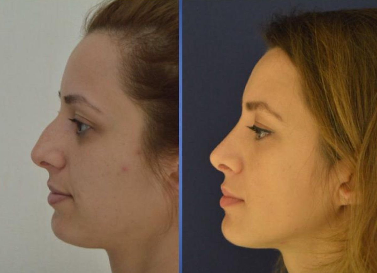 Before and after revision rhinoplasty result at Istanbul Aesthetic Plastic Surgery Center