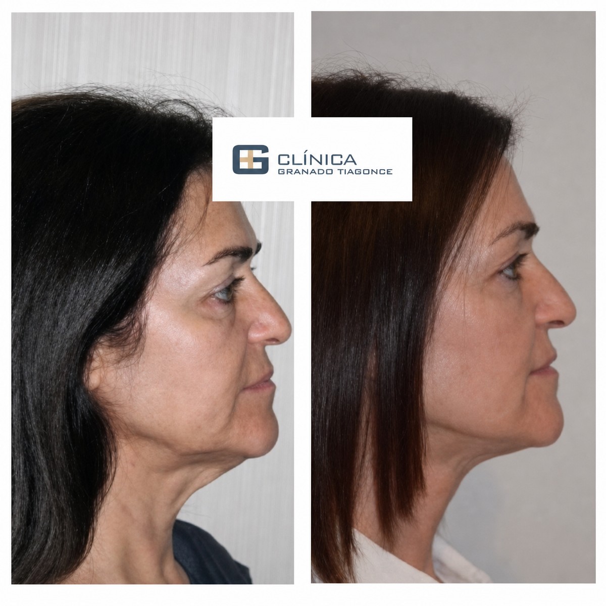 نتائج شد الوجه بالمنظار قبل وبعد في Clinica Granado Tiagonce، تجديد شباب الوجه