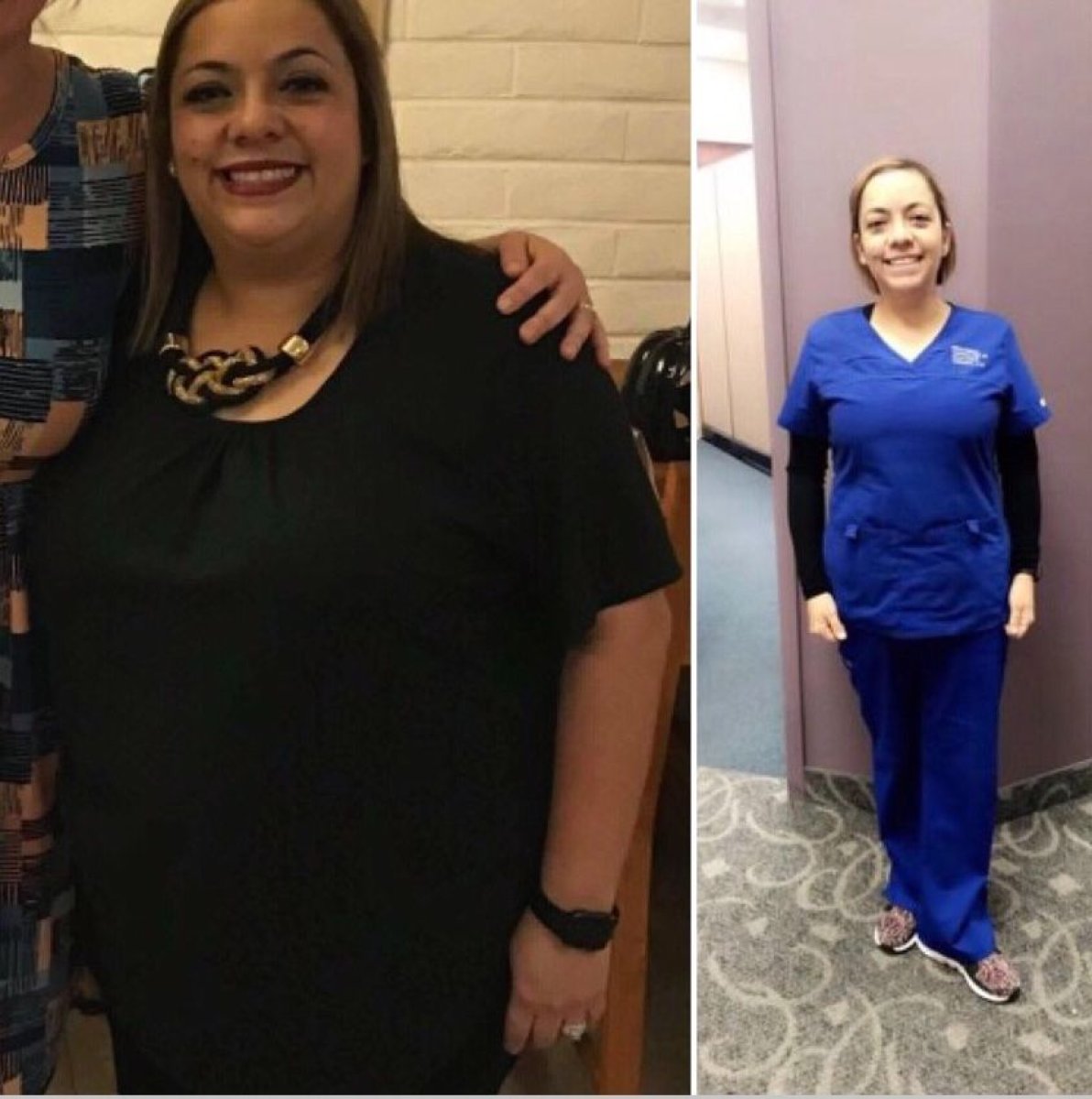Before and after gastric balloon results at Hospital de la Familia, visible weight loss achieved