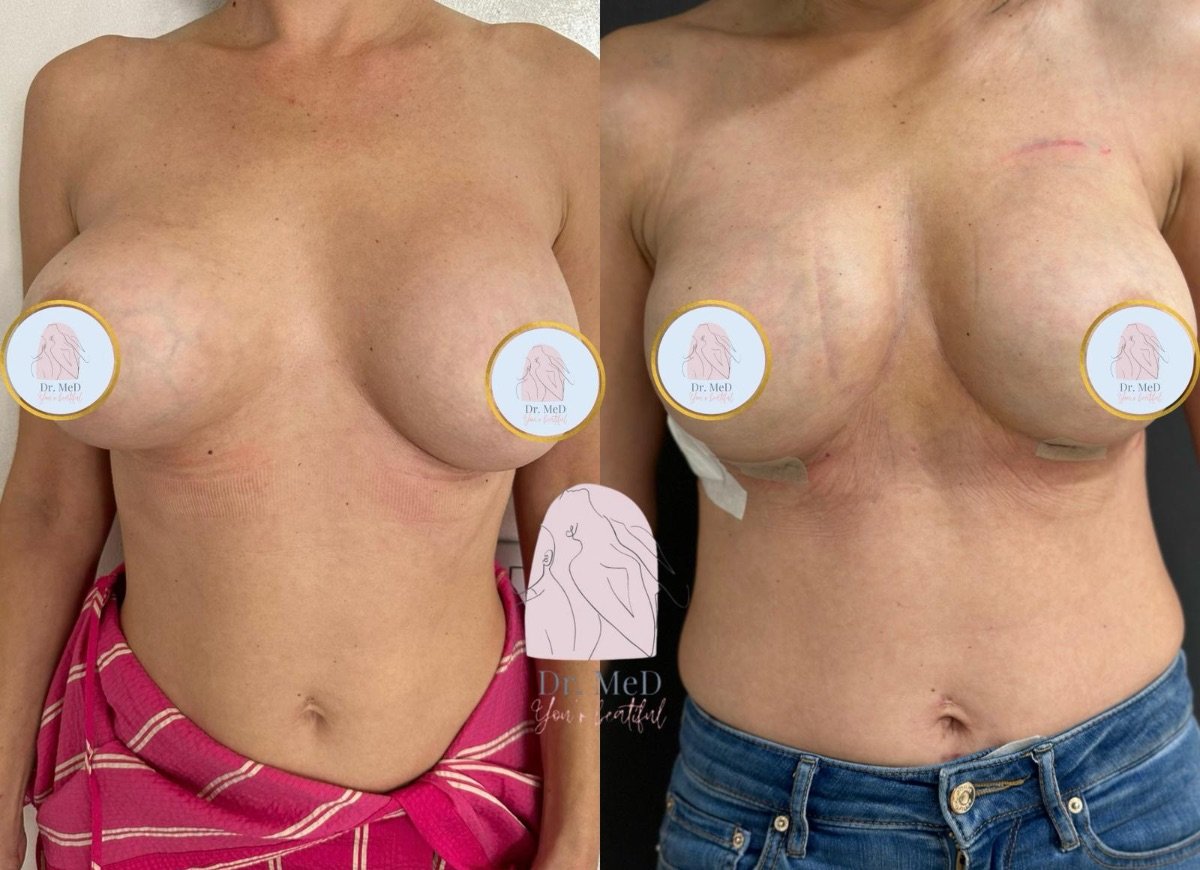 نتائج شد الثدي قبل وبعد في عيادة Dr. MED، تحسين شكل وتناسق الثديين