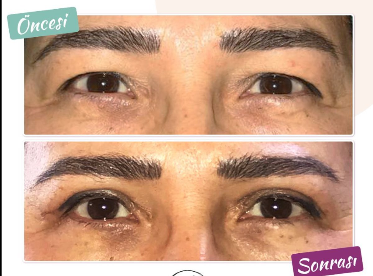 Blepharoplasty before and after result at Dunyagoz Eye Hospital Istanbul Etiler, eyelid correction