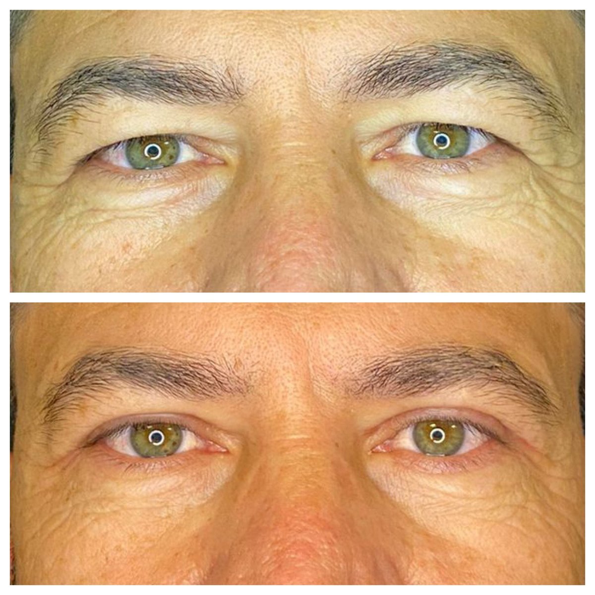 Before and after blepharoplasty results at Dunyagoz Eye Hospital Antalya, eyelid correction