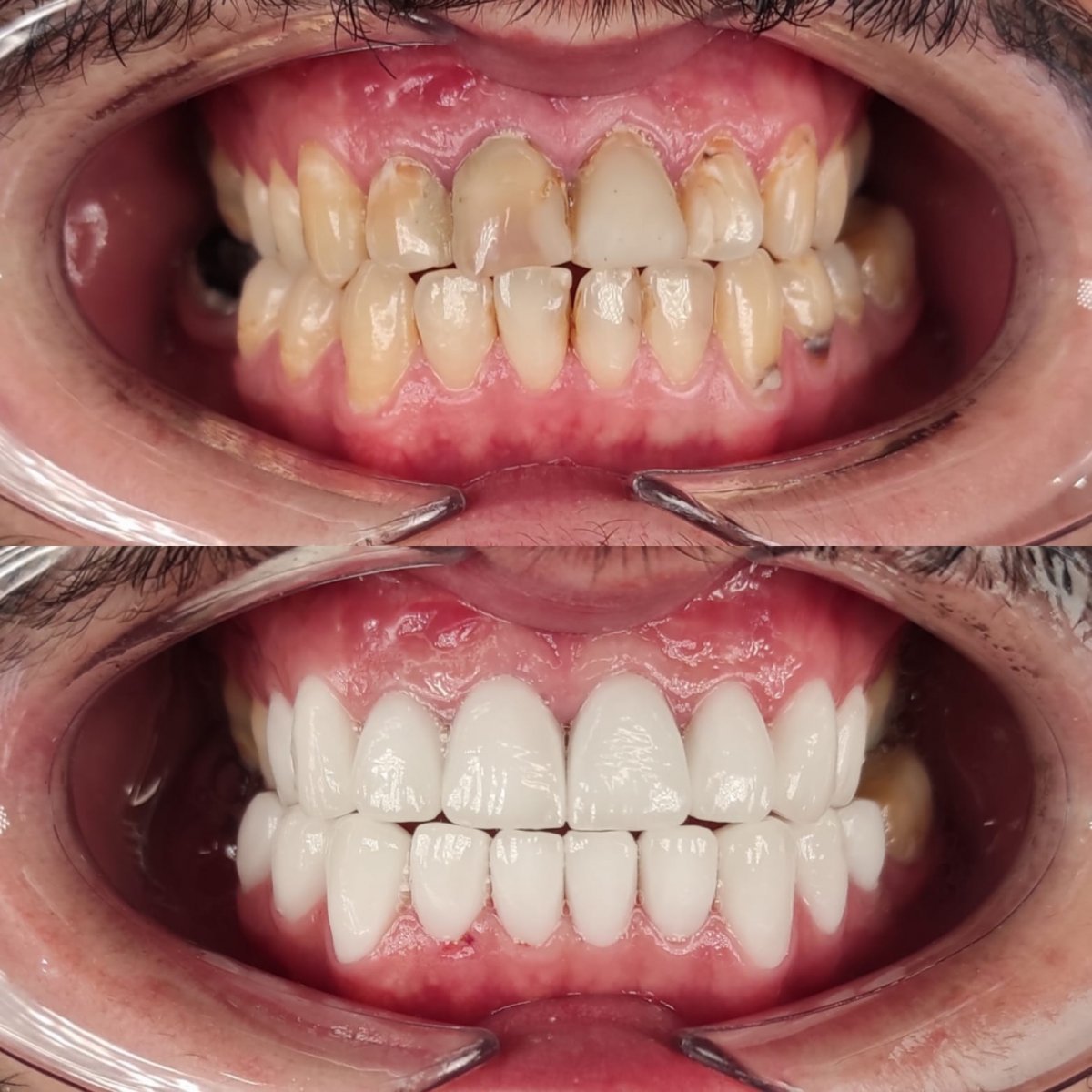 Before and after tooth restoration (bonding) results at WestDent Clinic, improved smile