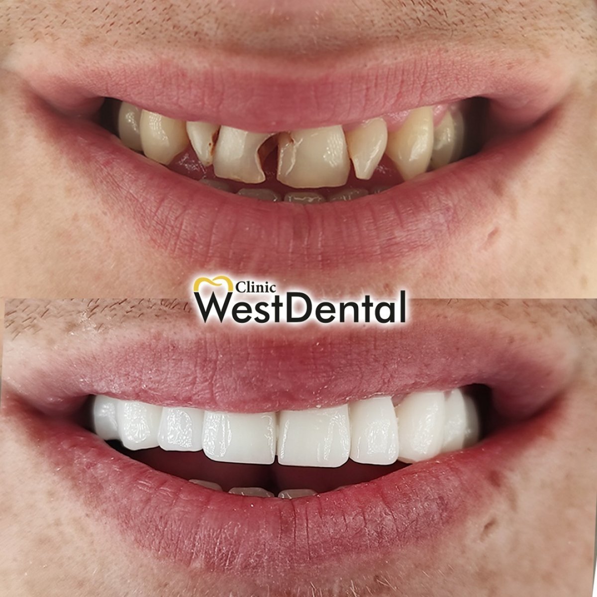 Before and after tooth restoration (bonding) results at WestDent Clinic, improved smile