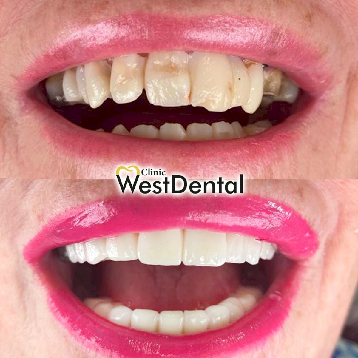 Résultats avant/après restauration dentaire (bonding) à WestDent Clinic, sourire amélioré