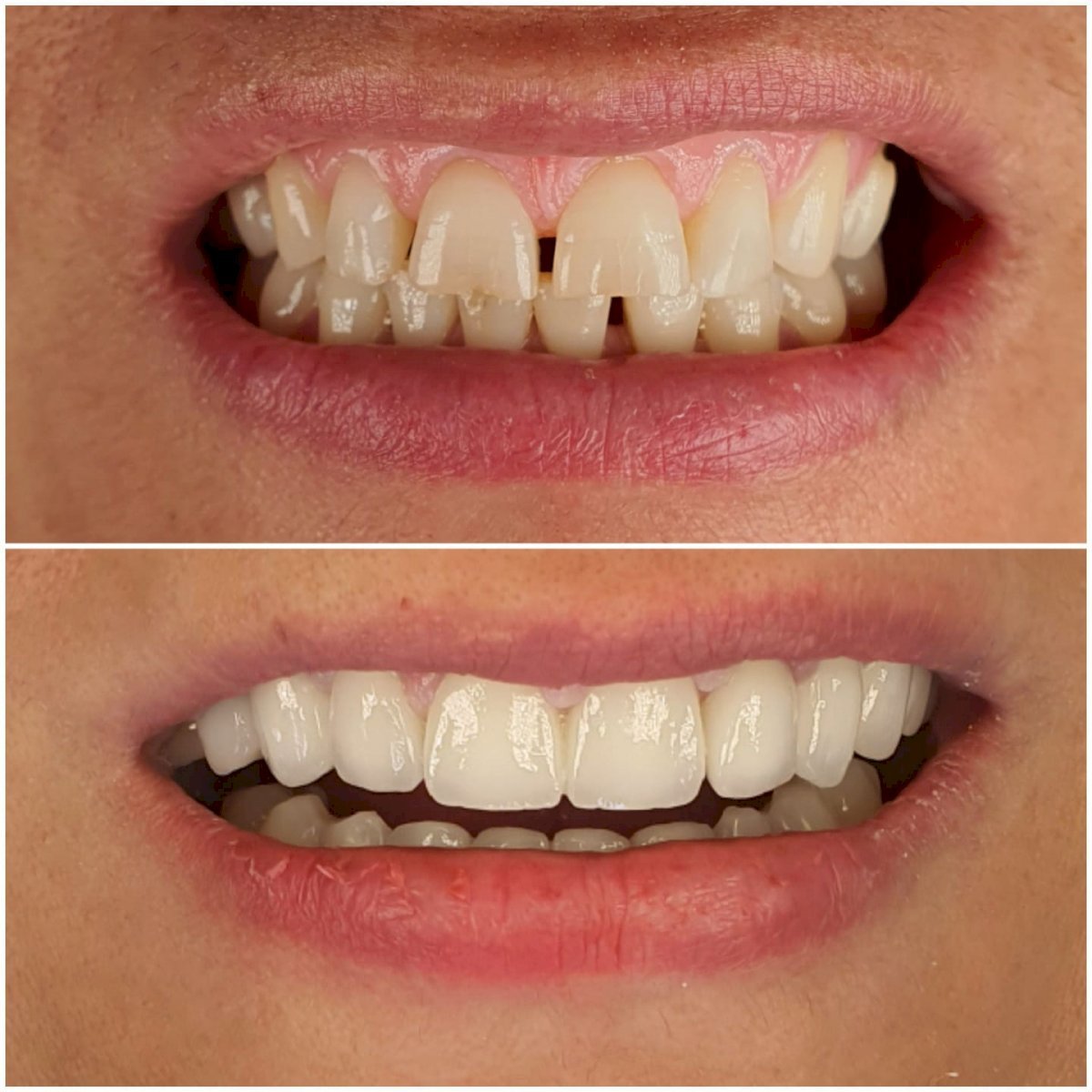 Avant et après facettes Emax à la WestDent Clinic – sourire naturel et transformé