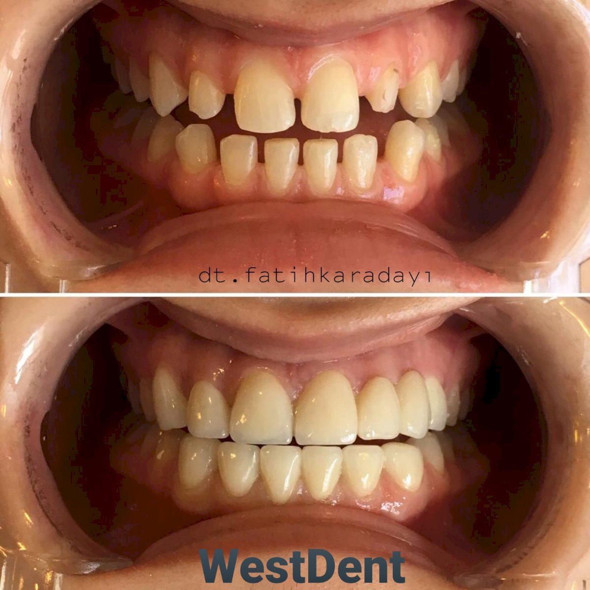 Resultados antes y después de carillas Emax en WestDent Clinic – sonrisa alineada y blanca