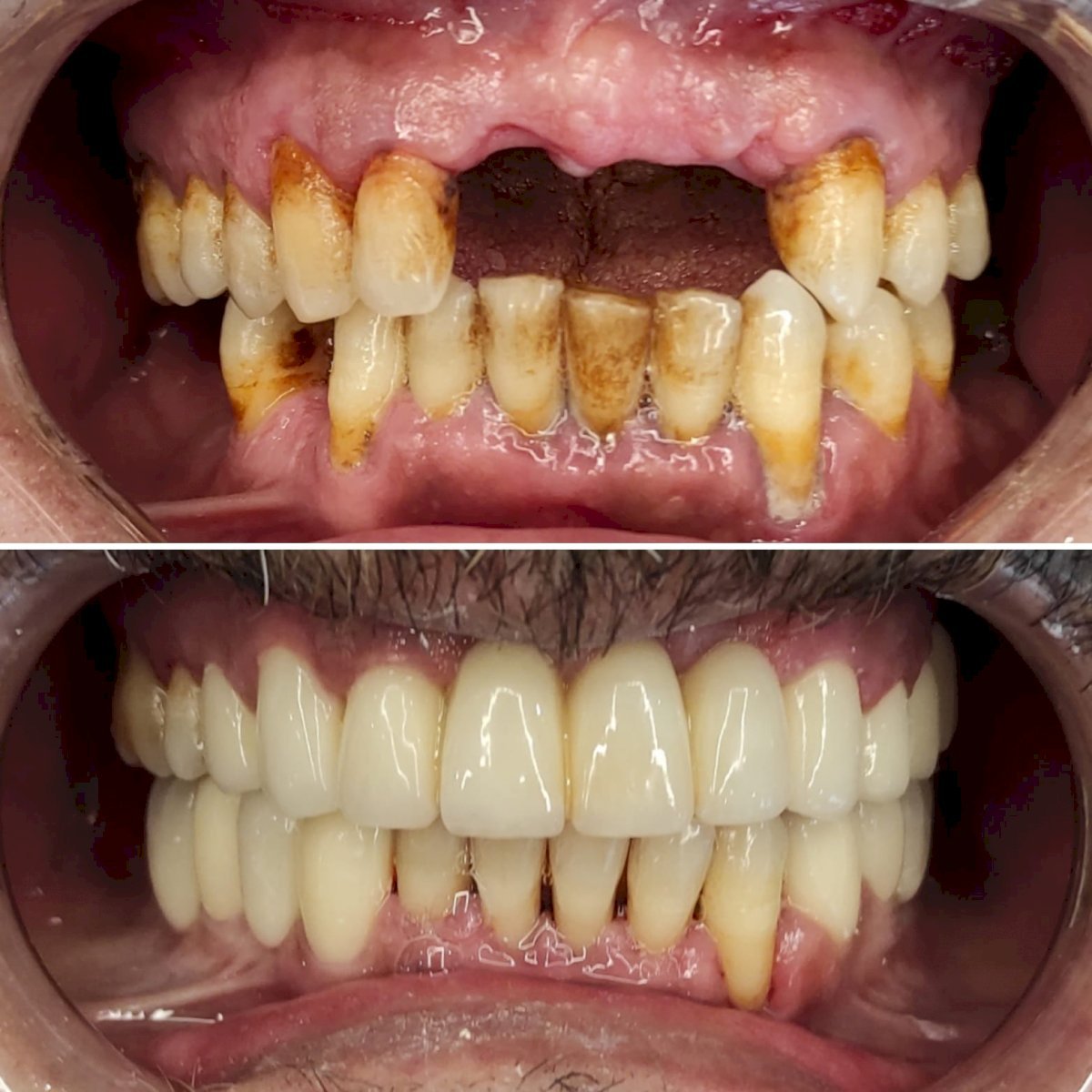 Before and after Emax veneers at WestDent Clinic – smile makeover and whiter teeth result
