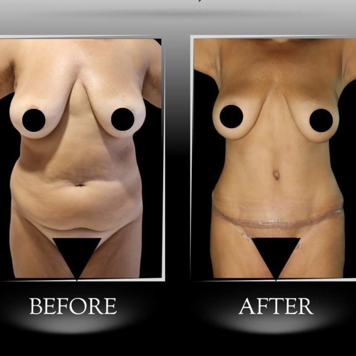 Before and after Vaser 3 areas plus tummy tuck results at Dr. Ilker Manavbasi's Clinic