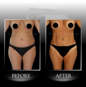 360° VASER + Tummy Tuck — Companion Stay & 6 Nights Included - photo 4