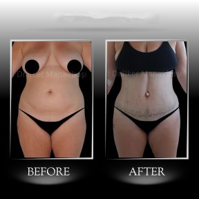 360° VASER + Tummy Tuck — Companion Stay & 6 Nights Included - photo 5