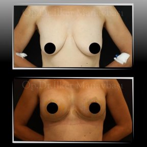 Breast Lift with Implants — Companion Stay & Special Bra Included - photo 5
