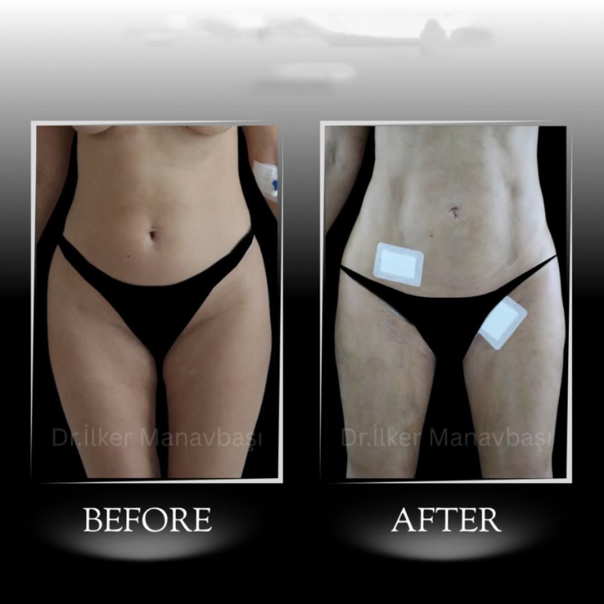 Before and after Vaser liposuction results at Dr. Ilker Manavbasi's Clinic, abdomen and thighs