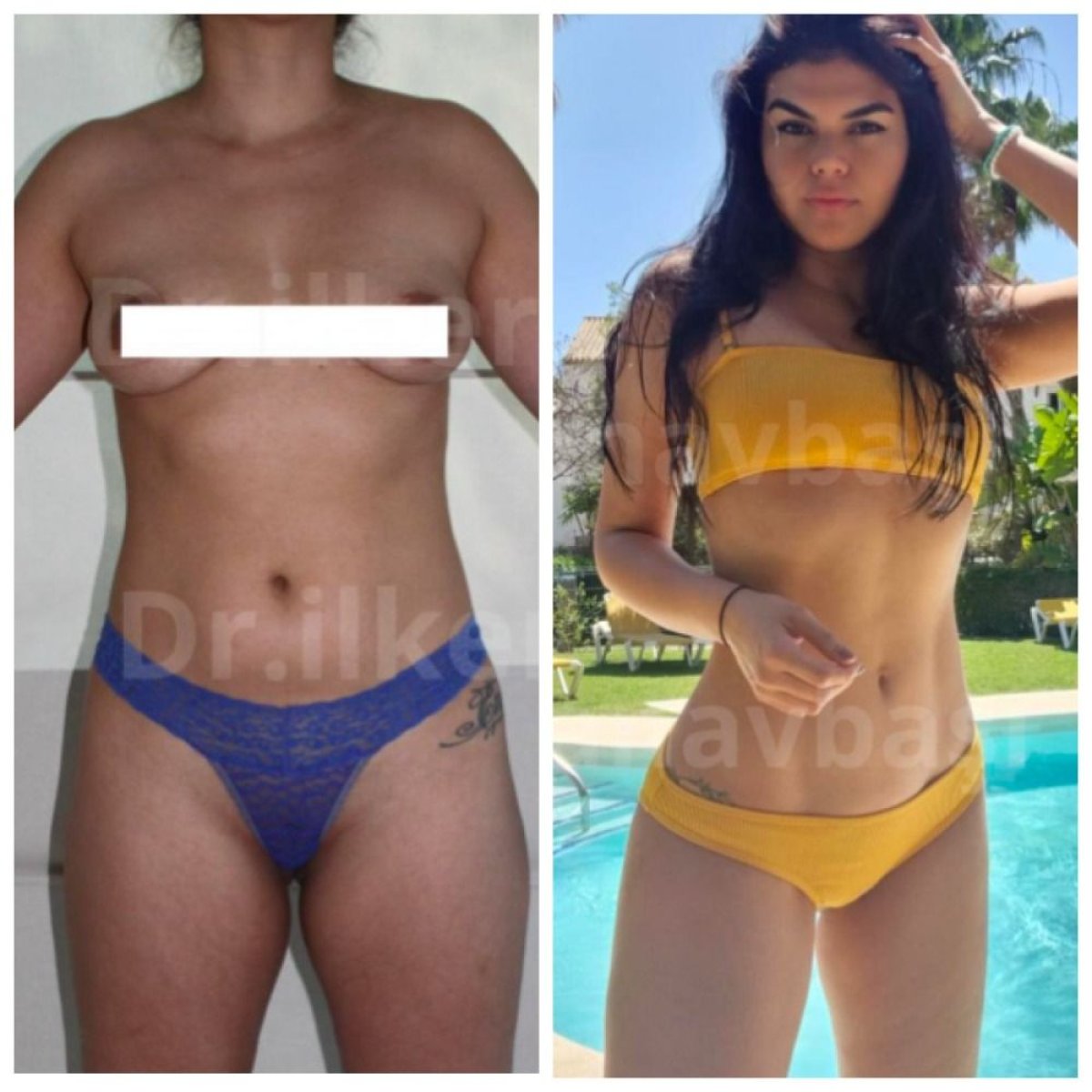 Before and after Vaser liposuction results at Dr. Ilker Manavbasi's Clinic, body contouring