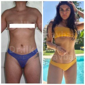 360° VASER Liposuction — 5 Nights at 4★ Hotel, Companion Stay & Lymphatic Massage - photo 5