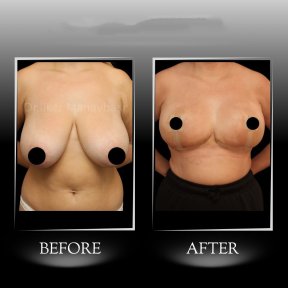 Breast Lift — Companion Stay & Special Post-Op Bra Included - photo 6
