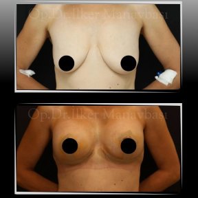 Breast Lift — Companion Stay & Special Post-Op Bra Included - photo 5