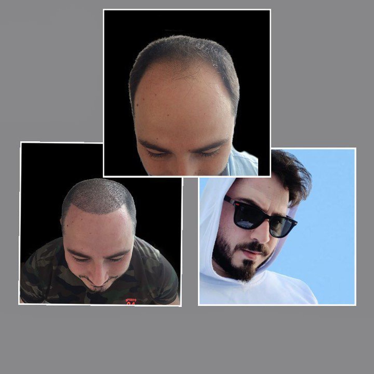 FUE hair transplant before and after results at Dr. Ilker Manavbasi's Clinic, restored hairline