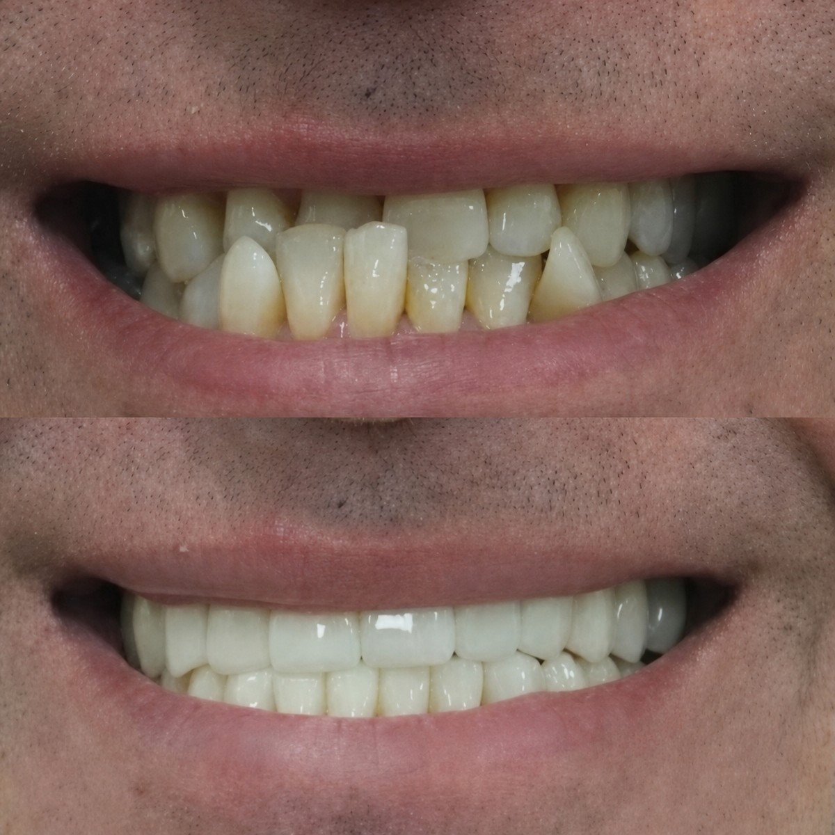 Resultados antes y después de Hollywood Smile en Excelentis Dental Center, cambio de sonrisa
