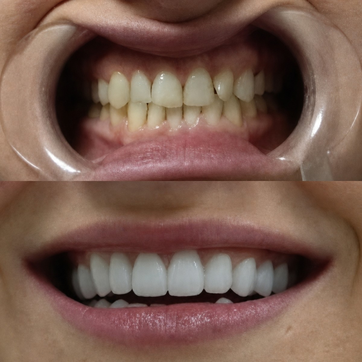 Résultats avant et après Hollywood Smile chez Excelentis Dental Center, blanchiment et facettes