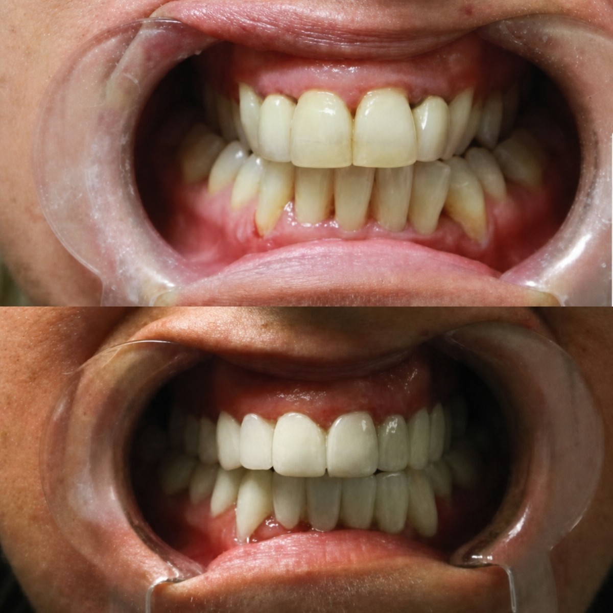 Resultados antes y después de Hollywood Smile en Excelentis Dental Center, dientes blancos y parejos