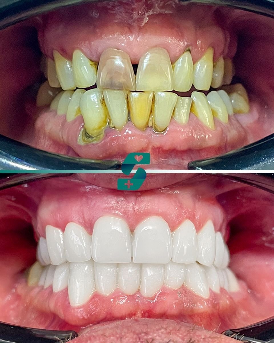 Porcelain crown installation before and after results at Soraca Med – smile restoration