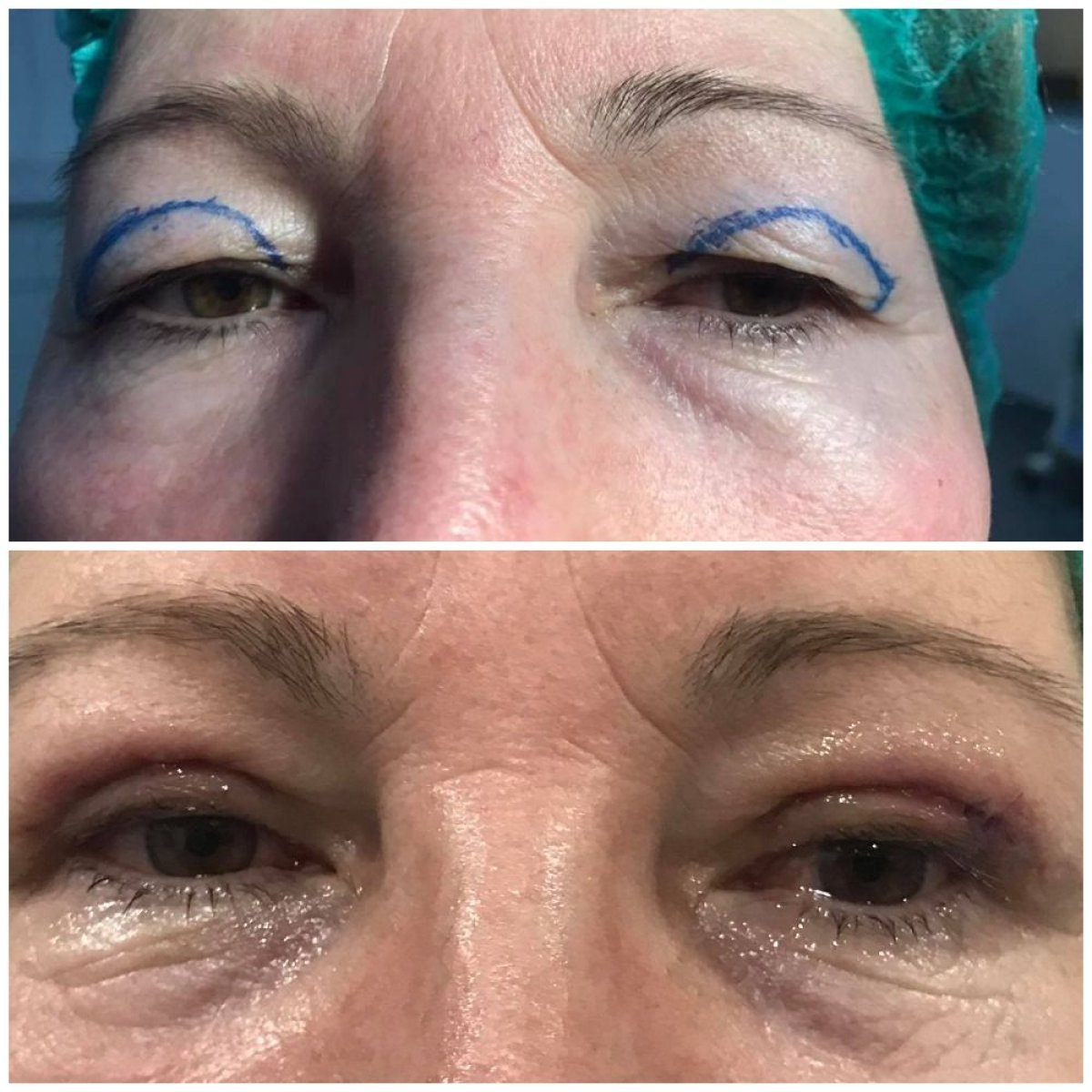 نتائج رأب الجفن قبل وبعد في Italian Eye Hospital، تصحيح الجفن العلوي