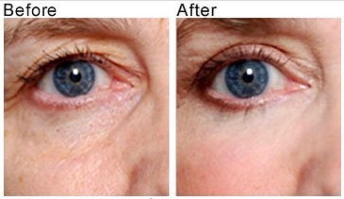 Результаты блефаропластики до и после в Italian Eye Hospital, коррекция век